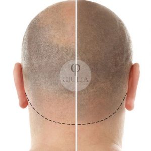 micropigmentacion capilar coronilla