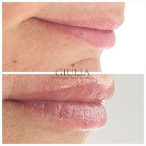 Aumento de labios con Micropigmentación de labios Aumento de labios con Micropigmentación de labios