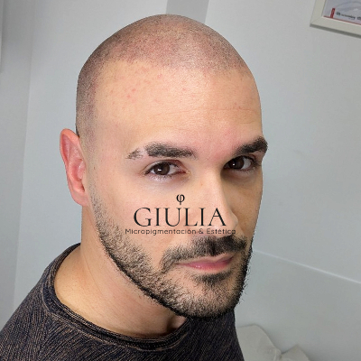 Micropigmentacion Capilar Clinica Giulia Alicante Micropigmentacion Capilar Alicante