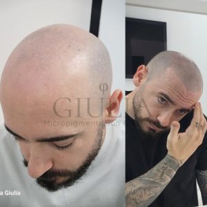 Micropigmentacion Capilar Giulia Alicante Micropigmentacion Capilar Giulia Alicante