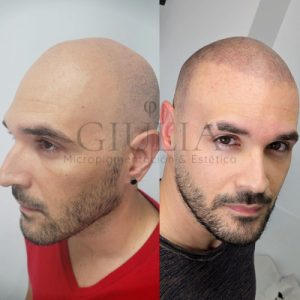 Tricopigmentacion Capilar Giulia Alicante Tricopigmentacion Capilar Giulia Alicante